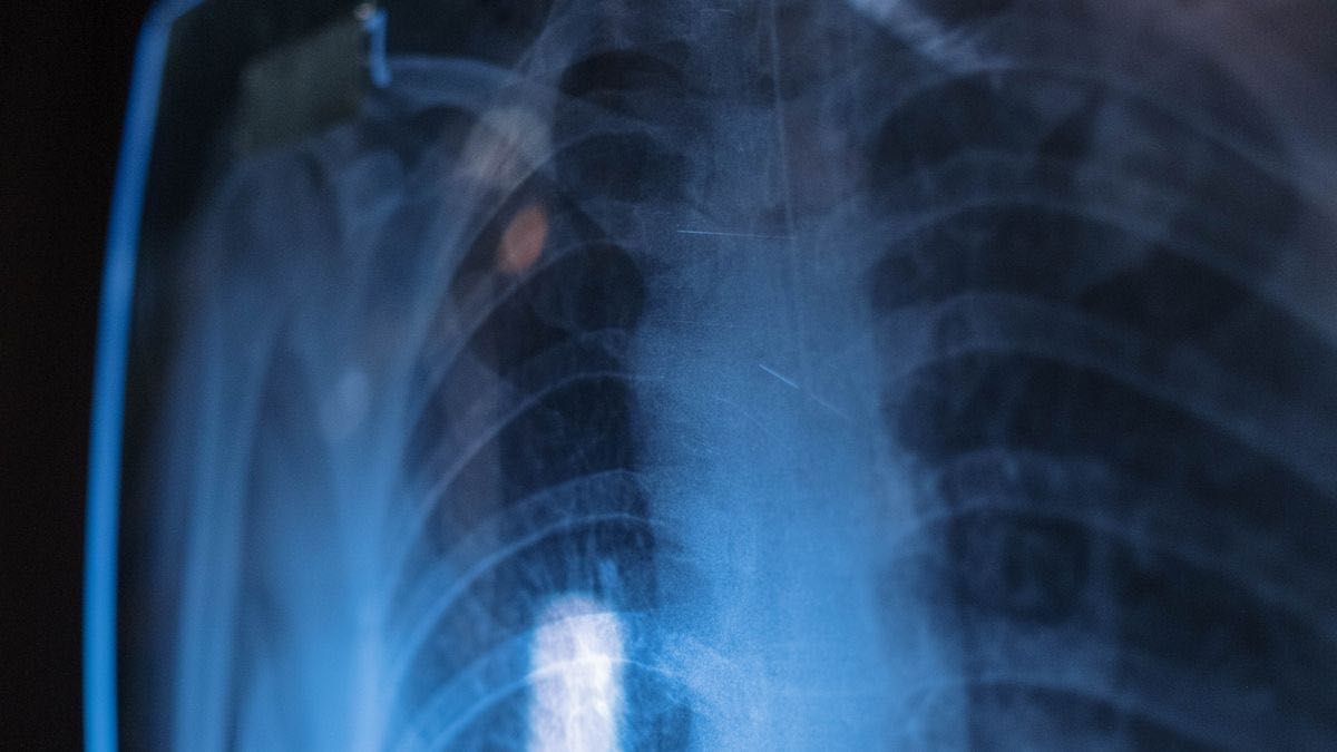 A chest X-ray film held up against the light on a dark background, a metaphor for X-ray search seeing through to public LinkedIn profiles